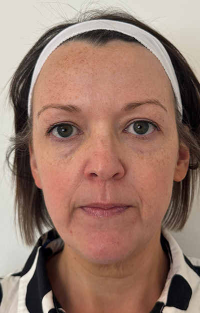 After Sculptra