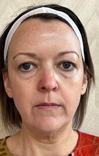 Before Sculptra